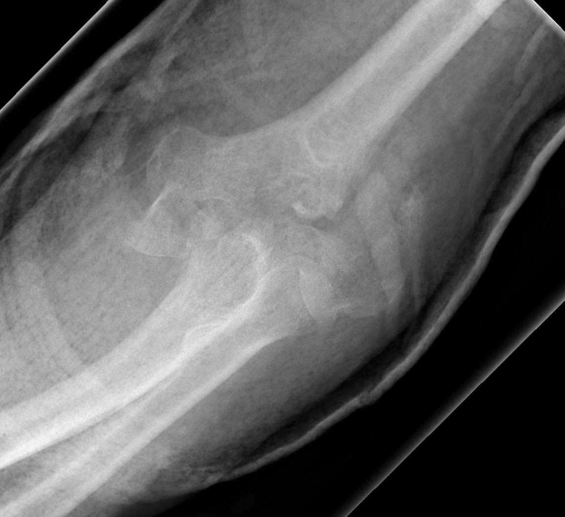 Distal Humerus Non Operative